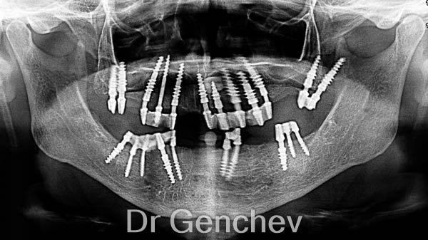 базални птеригоидни зъбни импланти