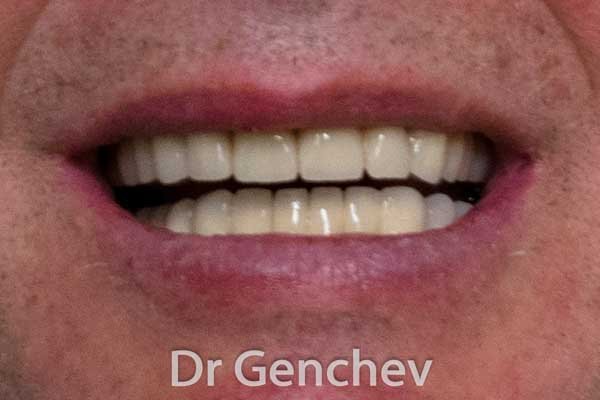пациент с бруксизъм след базални зъбни импланти