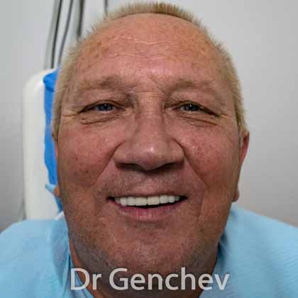 пациент с липсващи зъби се усмихва след поставане на базални зъбни импланти