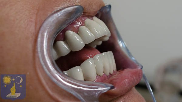пациентка с пародонтит след базални зъбни импланти България Пловдив Др Генчев