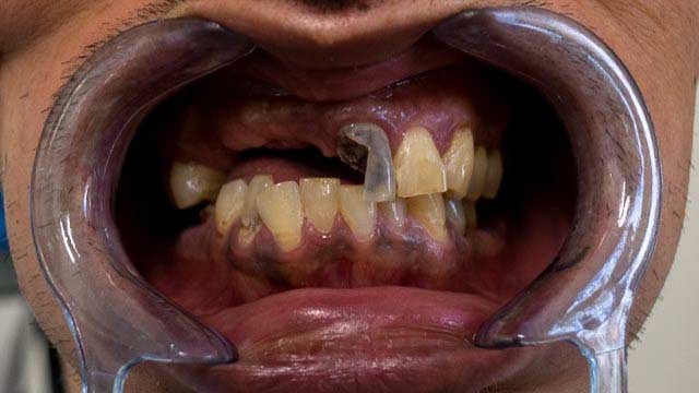 пациент с бруксизъм преди базални зъбни импланти България Пловдив Др Генчев
