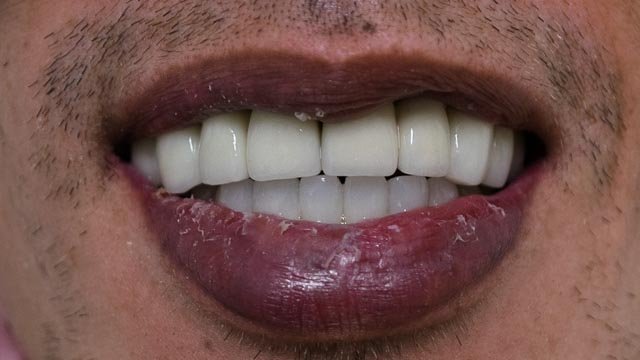 пациент с бруксизъм след базални зъбни импланти България Пловдив Др Генчев
