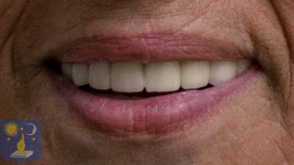 пациентка без зъби след базални зъбни импланти