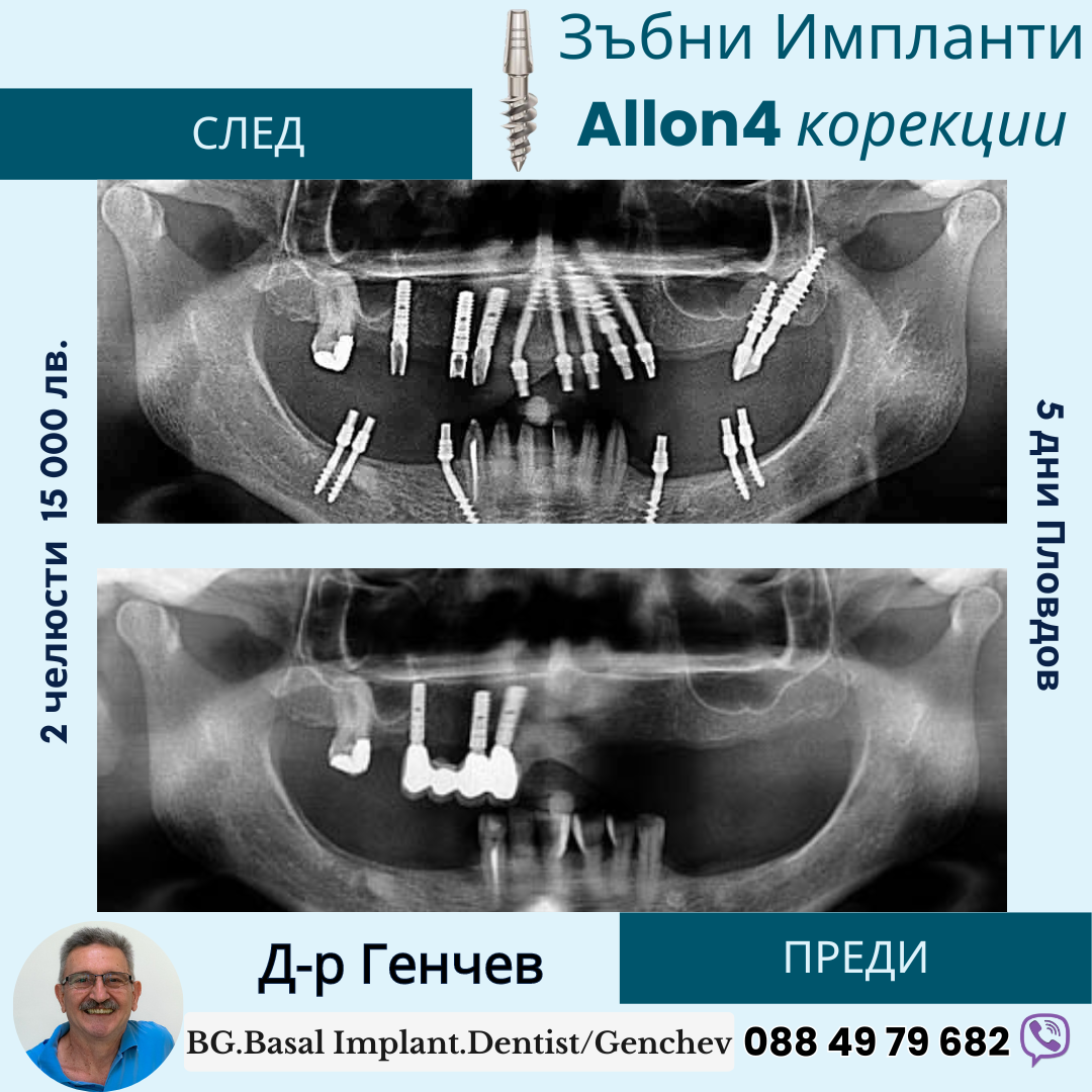 преди и после базални зъбни импланти