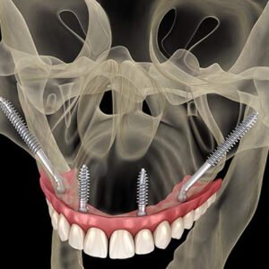 Птеригоидни зъбни импланти